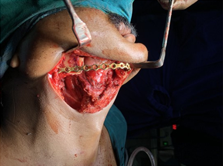 Jaw Bone Cancer